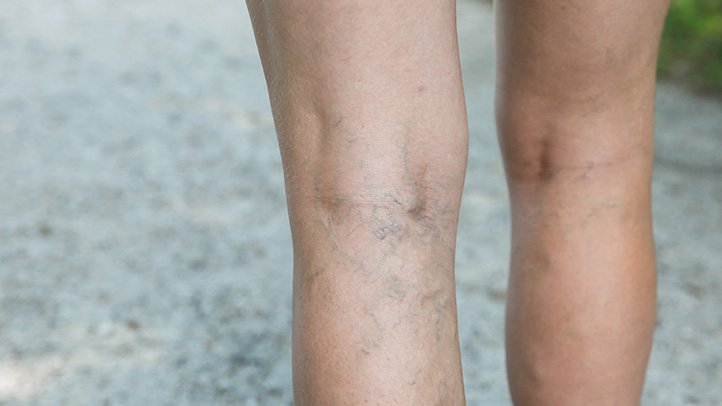 The Link Between Weight Loss and Spider Vein Reduction