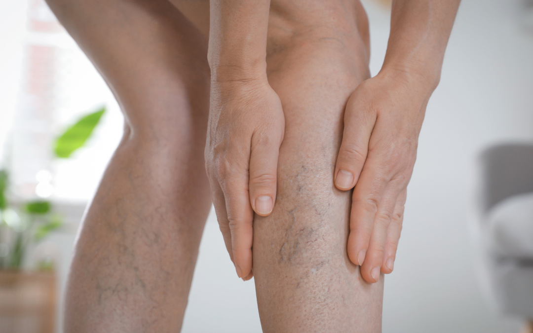 Who Is at Risk for Venous Insufficiency? Understanding Risk Factors