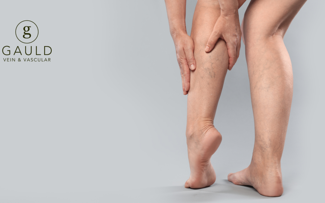 Long-Term Results: Can Varicose Veins Come Back?