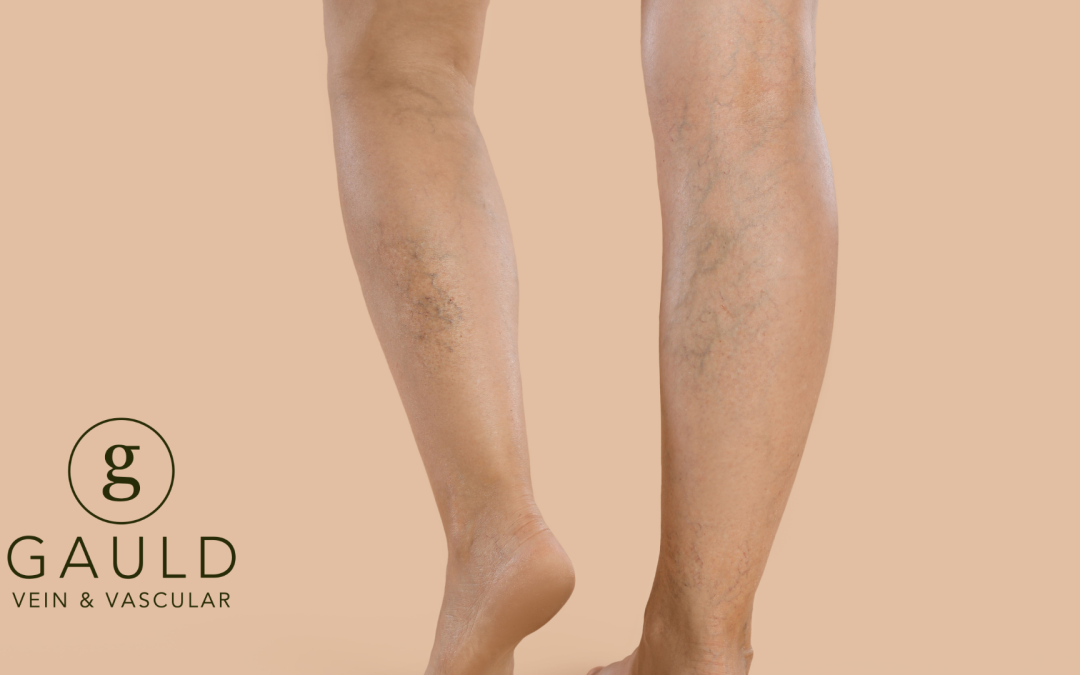 Insurance Coverage for Varicose Vein Treatment – What to Know