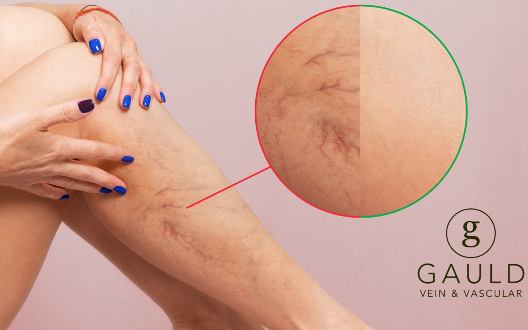 Frequently Asked Questions About Spider Veins