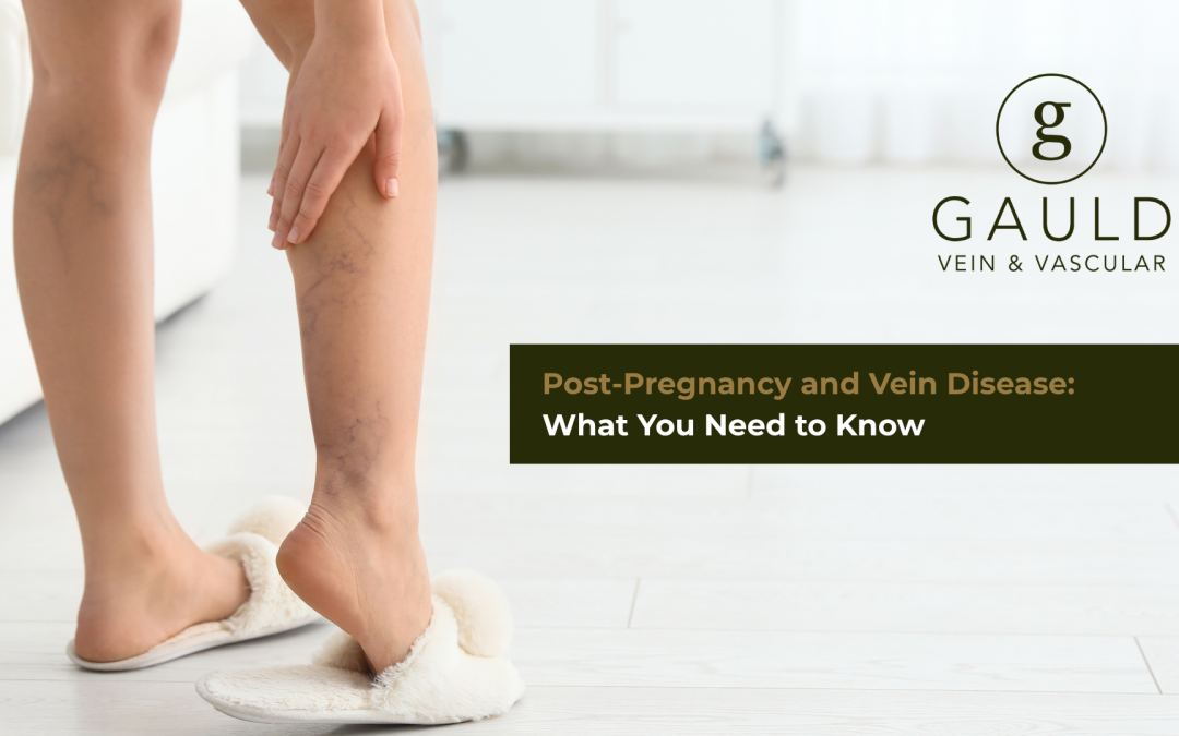 Post-Pregnancy and Vein Disease: What You Need to Know