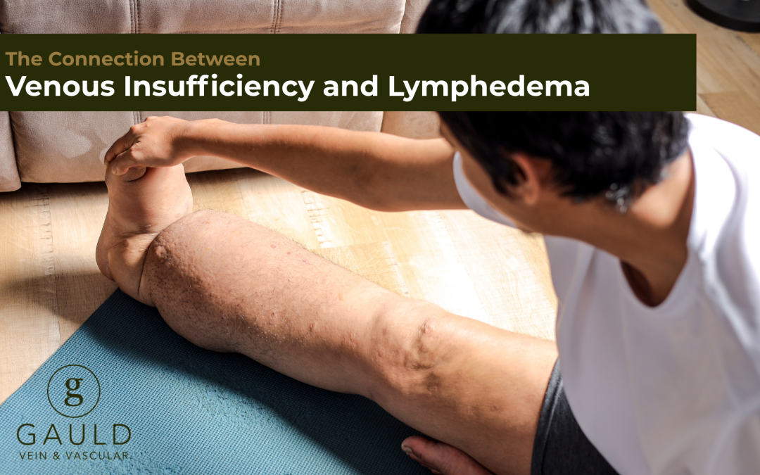 The Connection Between Venous Insufficiency and Lymphedema