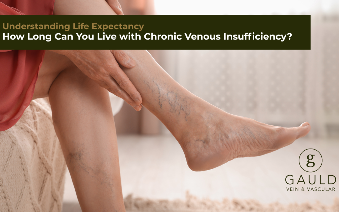 How Long Can You Live with Chronic Venous Insufficiency?