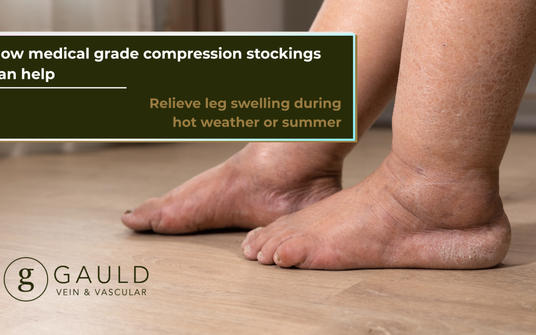 Summer Leg Swelling Relief: Medical Grade Compression Stockings